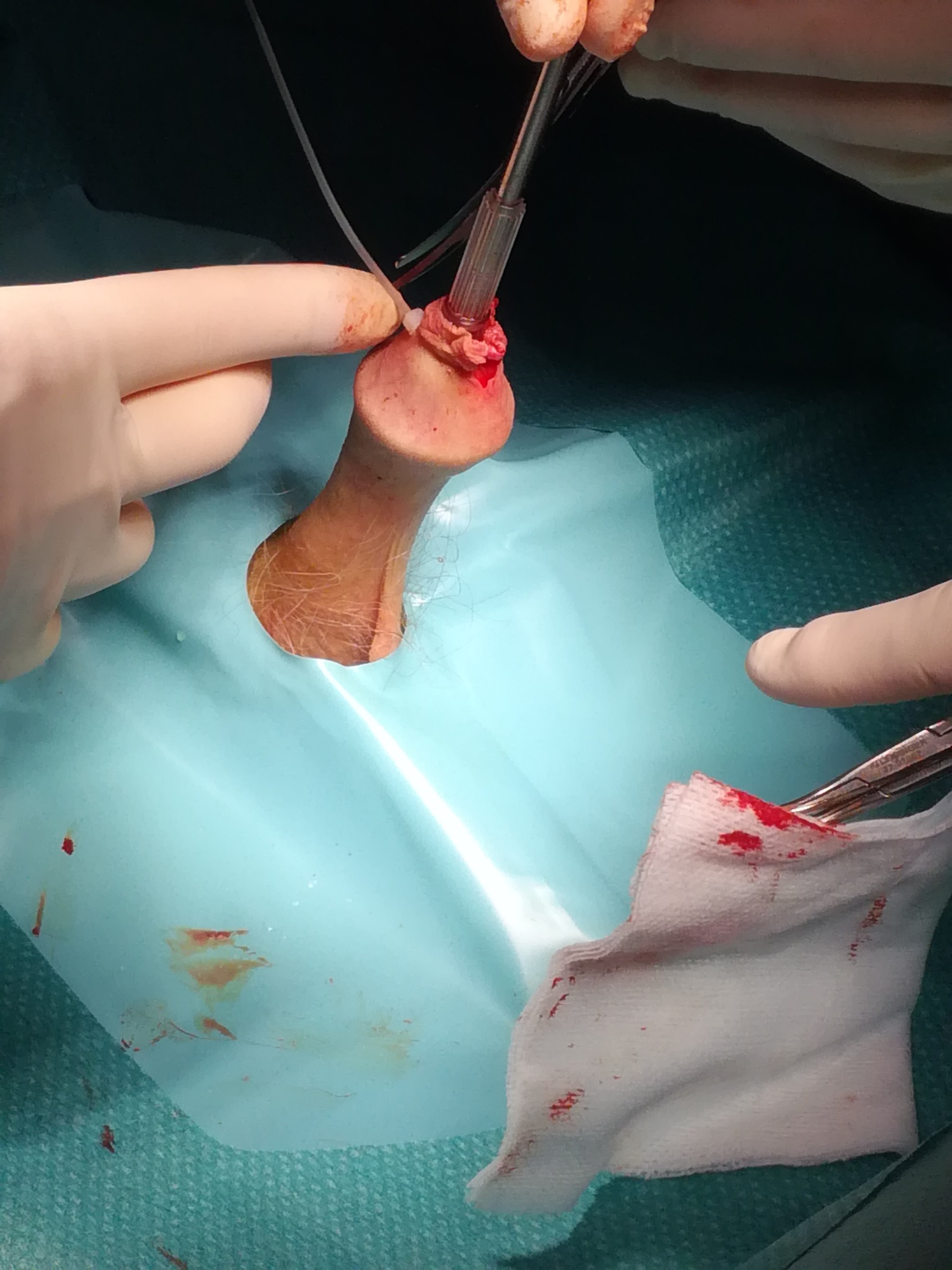 3-tie foreskin on galns bell